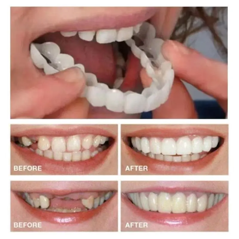 2pcs Comfortable And Flexible White Denture Veneers With Upper And Lower Denture Accessories, Unisex, Easy-to-Wear Dental Accessories - The Ultimate Denture Veneer Solution To Boost Your Confidence