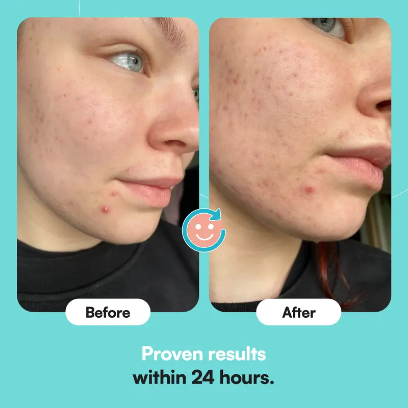 Breakout Patch Classic’s Holy Grail | Face, Body, Nose & Pimple Patches Bundle | Award-Winning | Hydrocolloid Acne Patch & Pore Strips to Absorbs Pus & Oil, Unclog & Shrink Pores | Spot Treatment + Blackhead Remover | Vegan & Cruelty-Free 4